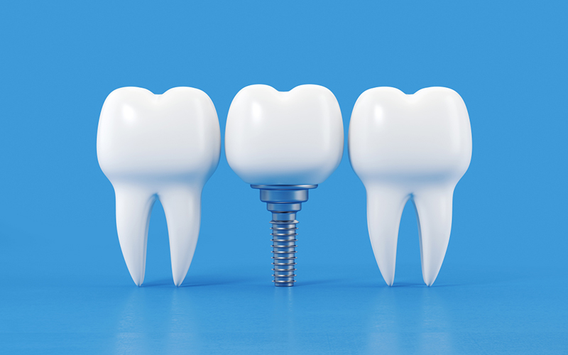 Dental implant education materials at Fusion Implant Dentistry