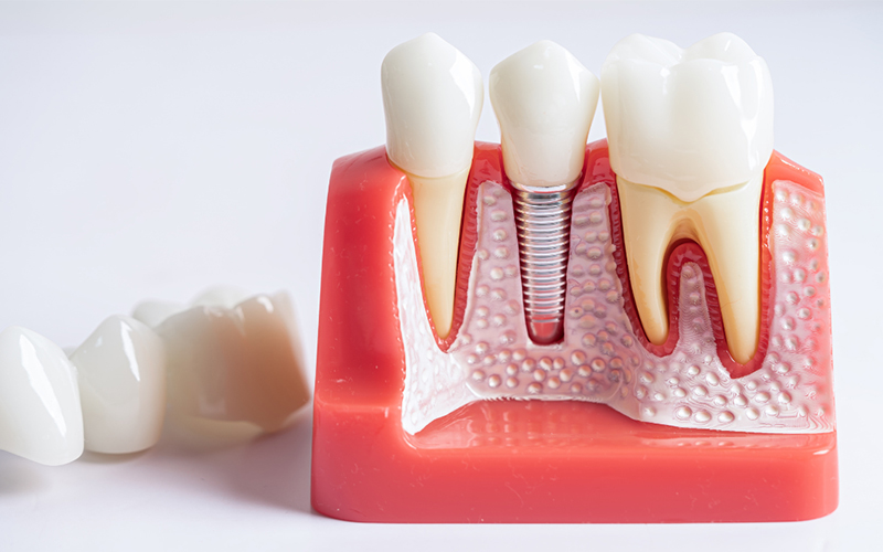 Implant dentistry myths debunked infographic at Fusion Implant Dentistry