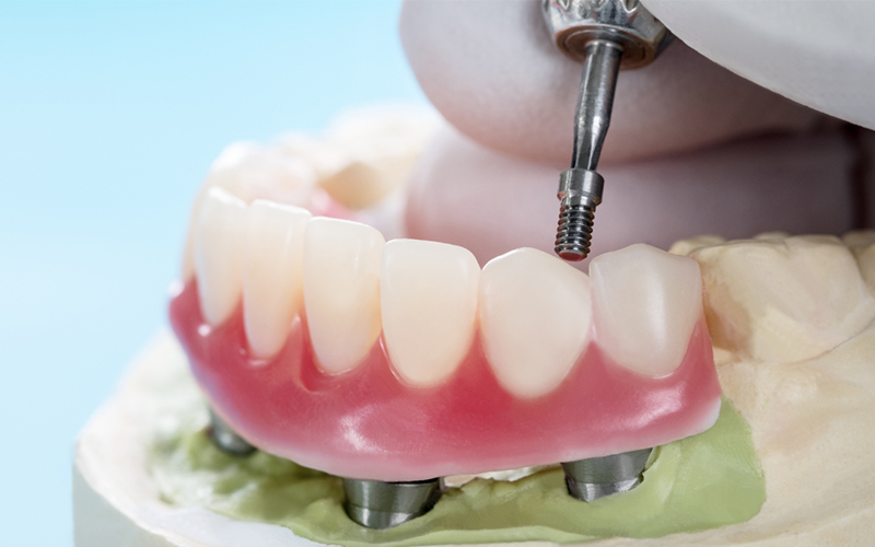 Implant supported dentures comparison chart at Fusion Implant Dentistry